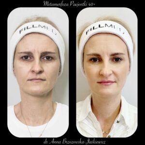 Metamorfoza pacjentki 40 +